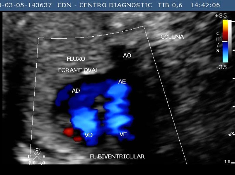 O que é a Ecocardiografia Fetal?